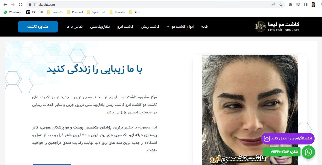همکاری با یک کلینیک کاشت مو لیما در تهران